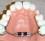 palatal expander